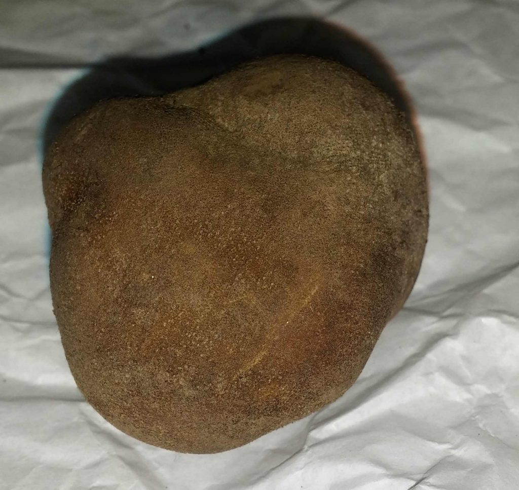 tuber excavatum